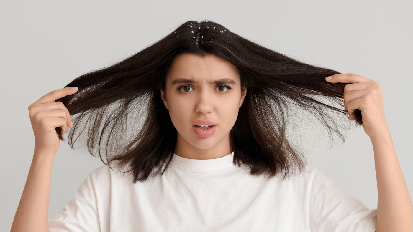 10 natural remedies for getting Rid of Dandruff